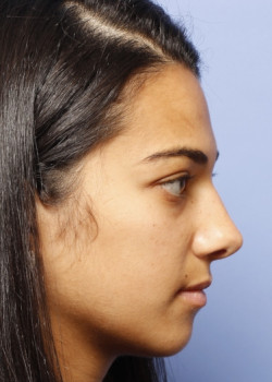 Rhinoplasty – Case 8