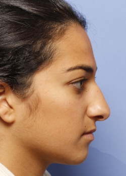 Rhinoplasty – Case 8