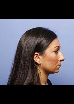 Rhinoplasty – Case 10