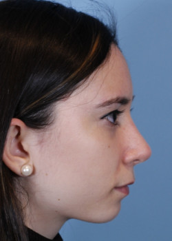 Rhinoplasty – Case 14