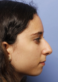 Rhinoplasty – Case 14