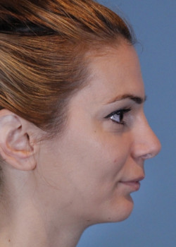 Rhinoplasty – Case 15