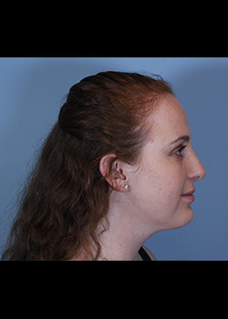 Rhinoplasty – Case 16