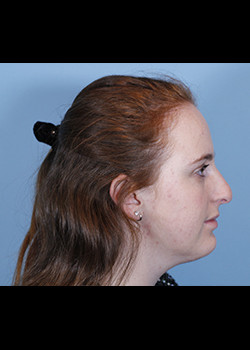 Rhinoplasty – Case 16