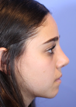 Rhinoplasty – Case 17