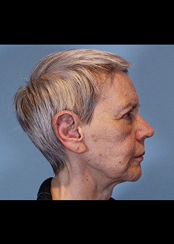 Rhinoplasty – Case 18