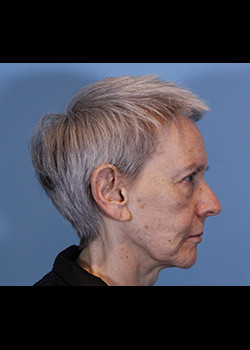 Rhinoplasty – Case 18