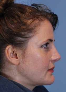 Rhinoplasty – Case 20