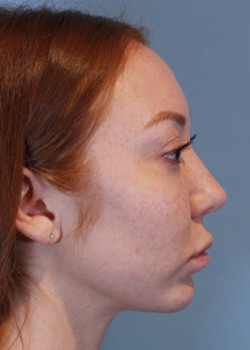 Rhinoplasty – Case 21