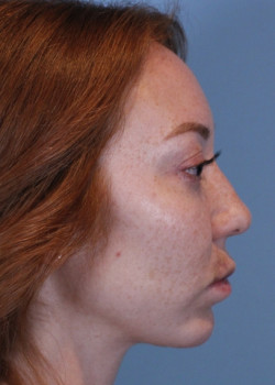 Rhinoplasty – Case 21