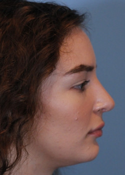 Rhinoplasty – Case 22