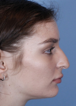 Rhinoplasty – Case 22