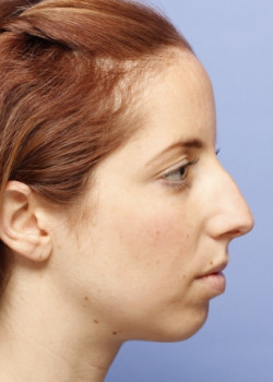 Rhinoplasty – Case 24