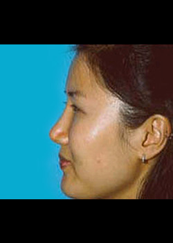 Female Ethnic Rhinoplasty – Case 1