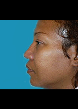 Female Ethnic Rhinoplasty – Case 2