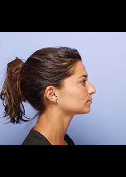 Ethnic Rhinoplasty – Case 5