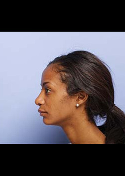 Ethnic Rhinoplasty – Case 8