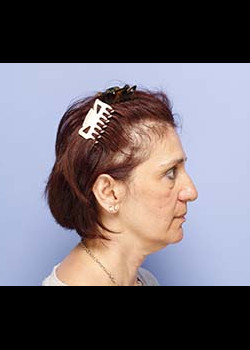 Facial Implants – Case 4