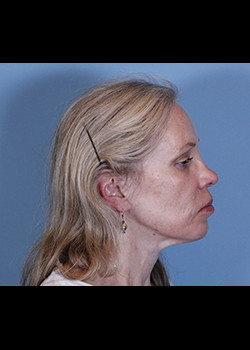 Facial Implants – Case 5