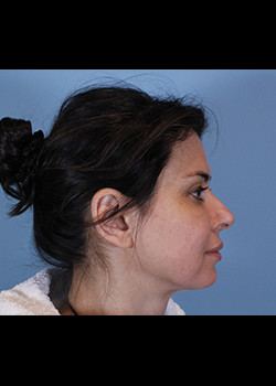 Facial Implants – Case 6