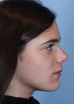 Revision Rhinoplasty – Case 1