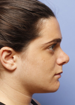 Revision Rhinoplasty – Case 1