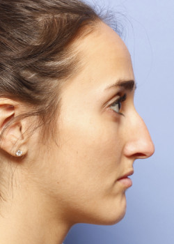 Revision Rhinoplasty – Case 2