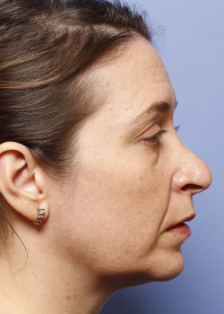 Revision Rhinoplasty – Case 4