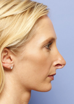 Revision Rhinoplasty – Case 5