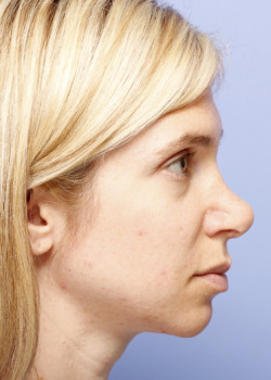 Revision Rhinoplasty – Case 6