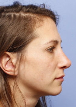 Revision Rhinoplasty – Case 7