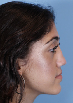 Revision Rhinoplasty – Case 8