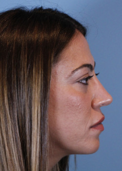 Revision Rhinoplasty – Case 9