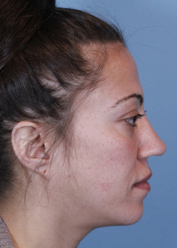 Revision Rhinoplasty – Case 9