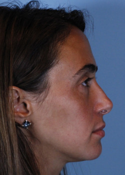 Revision Rhinoplasty – Case 10