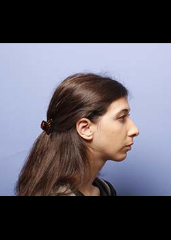 Female Ear Surgery – Case 1