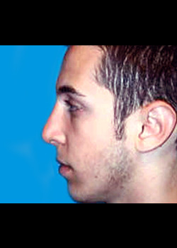 Male Ear Surgery – Case 1