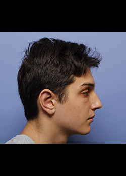 Ear Surgery – Case 4