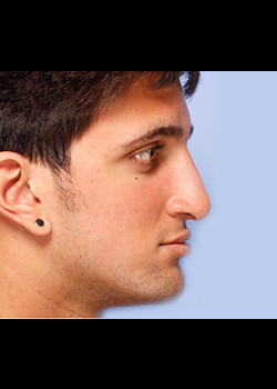 Male Ethnic Rhinoplasty – Case 1