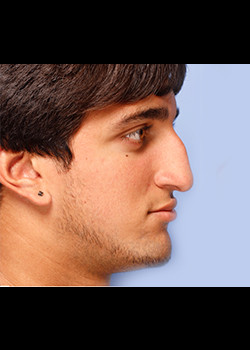 Male Ethnic Rhinoplasty – Case 1