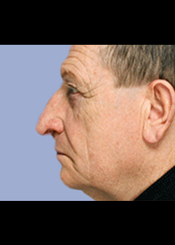 Facial Implants – Case 1