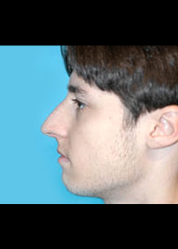 Male Rhinoplasty – Case 1