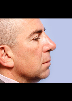 Rhinoplasty – Case 2