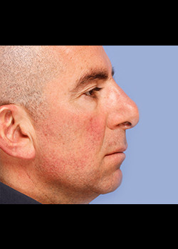 Rhinoplasty – Case 2