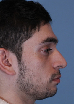 Rhinoplasty – Case 12