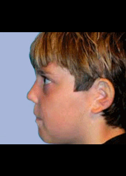 Microtia Surgery – Case 4