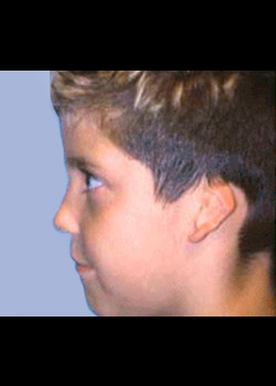 Microtia Surgery – Case 4