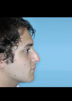 Male Rhinoplasty – Case 4