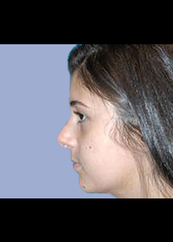 Rhinoplasty – Case 7