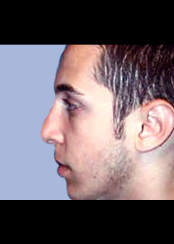 Rhinoplasty – Case 8